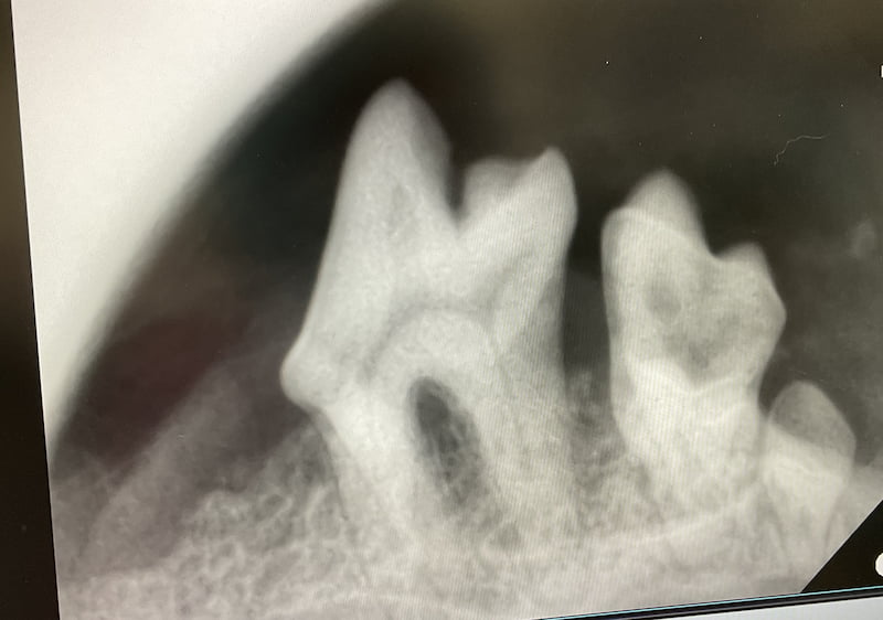 歯科レントゲン写真